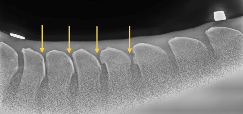 Kissing-Spine-szindroma1